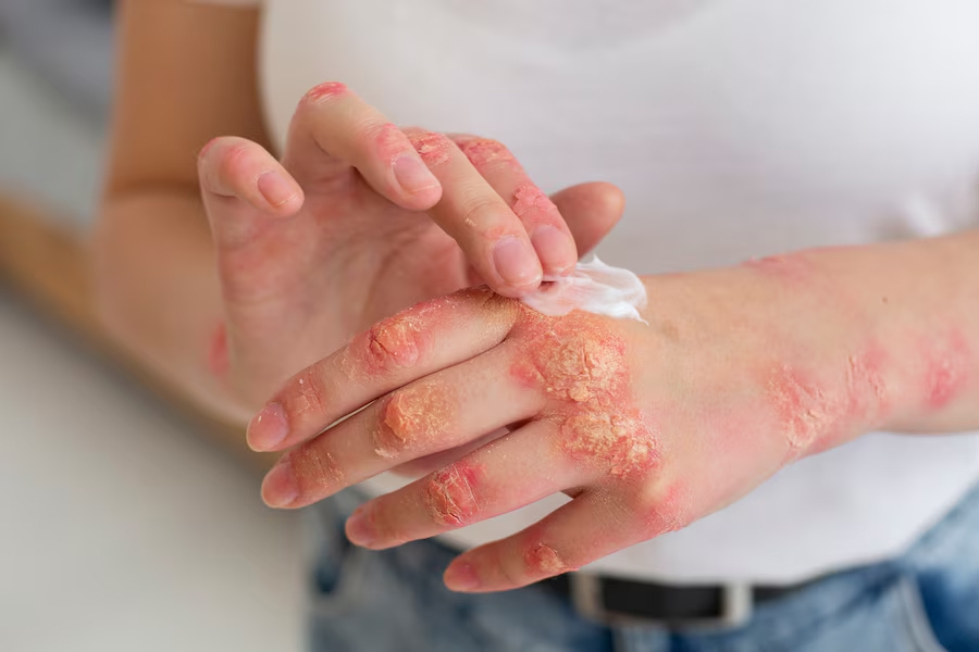 Dermatologist Shares Do's And Don'ts For Psoriasis Management